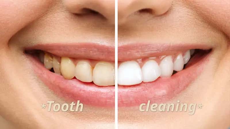 Tooth  cleaning 1