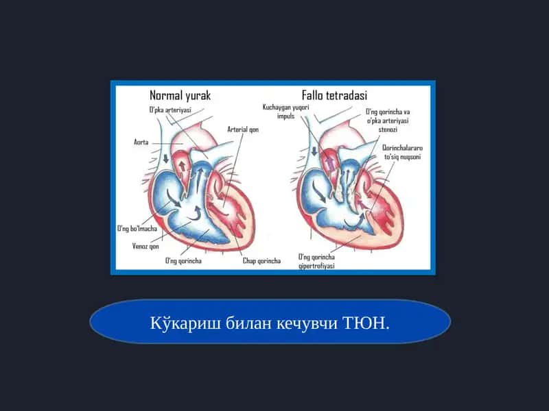 ТЮН (тўлиқ магистрал қон томирлар транспозицияси) 1