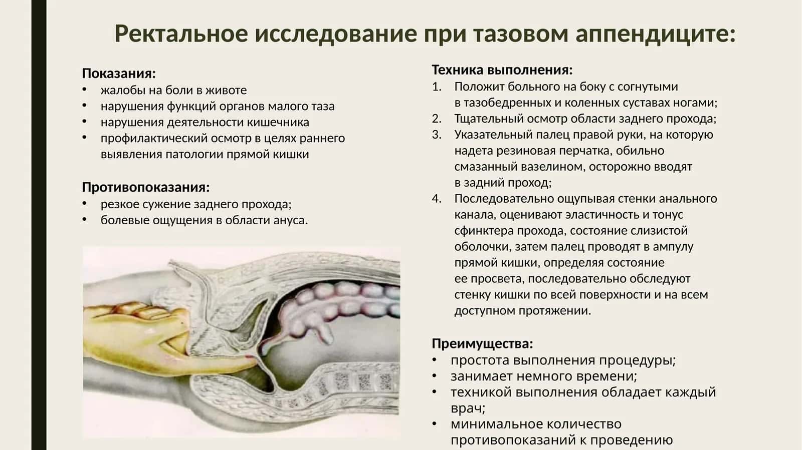 Ректальное исследование при тазовом аппендиците 1