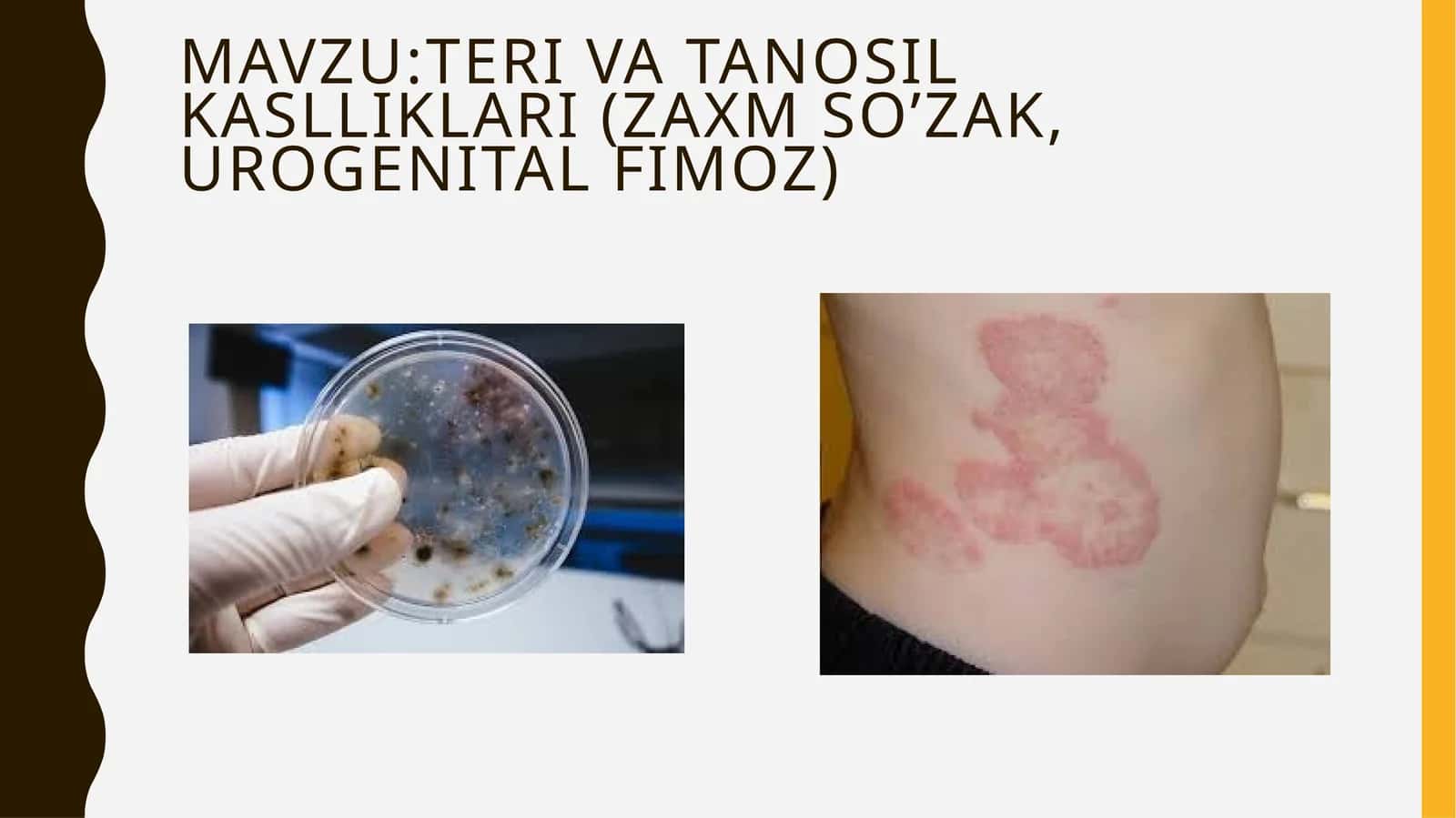 TERI VA TANOSIL KASLLIKLARI (ZaxMSO’ZAK, UROGENITAL FIMOZ) 1