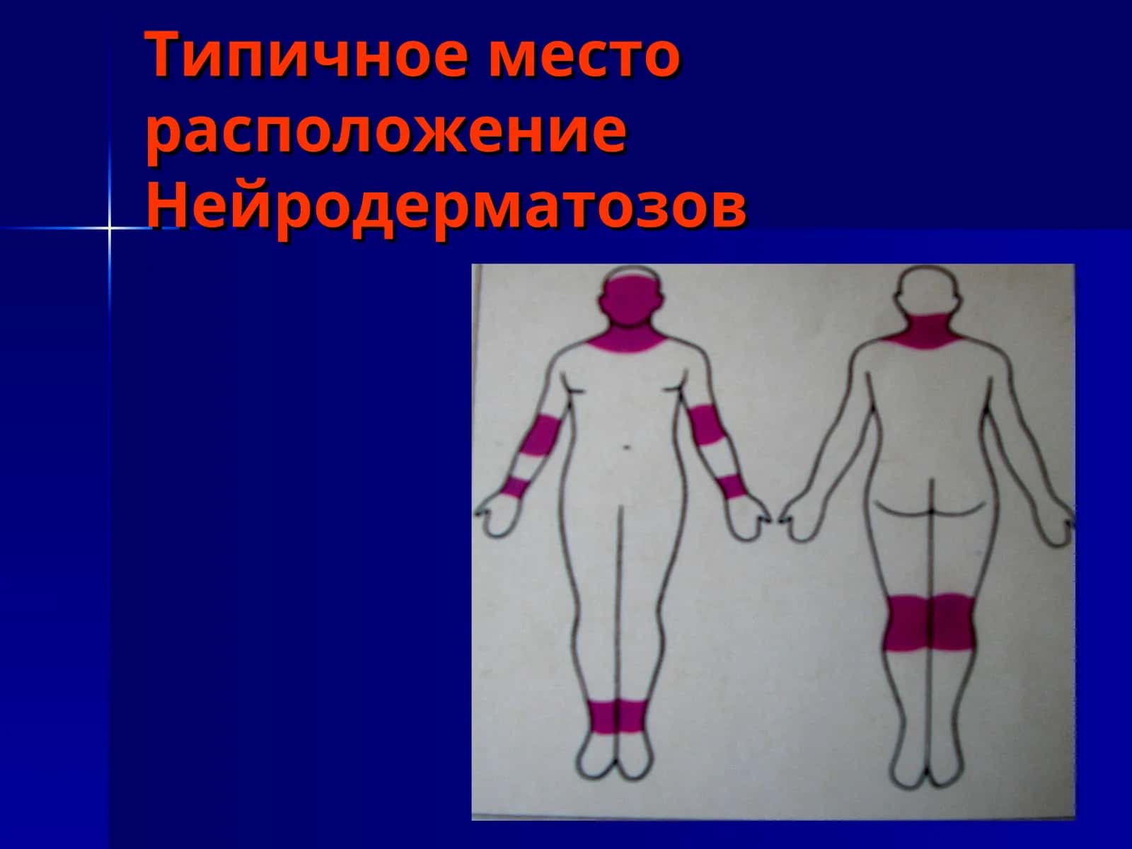 Типичное место расположение Нейродерматозов 1
