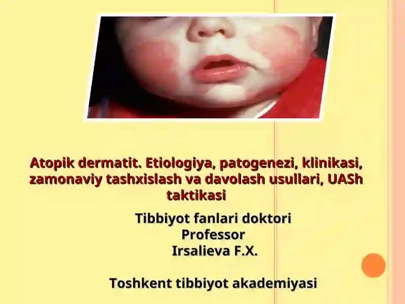 Atopik dermatit