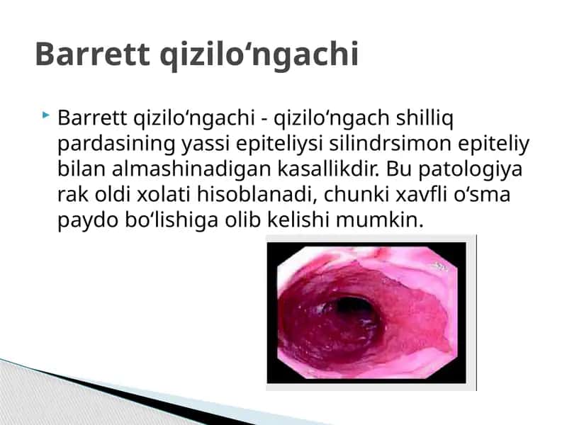 Barrett qizilo‘ngachi 1
