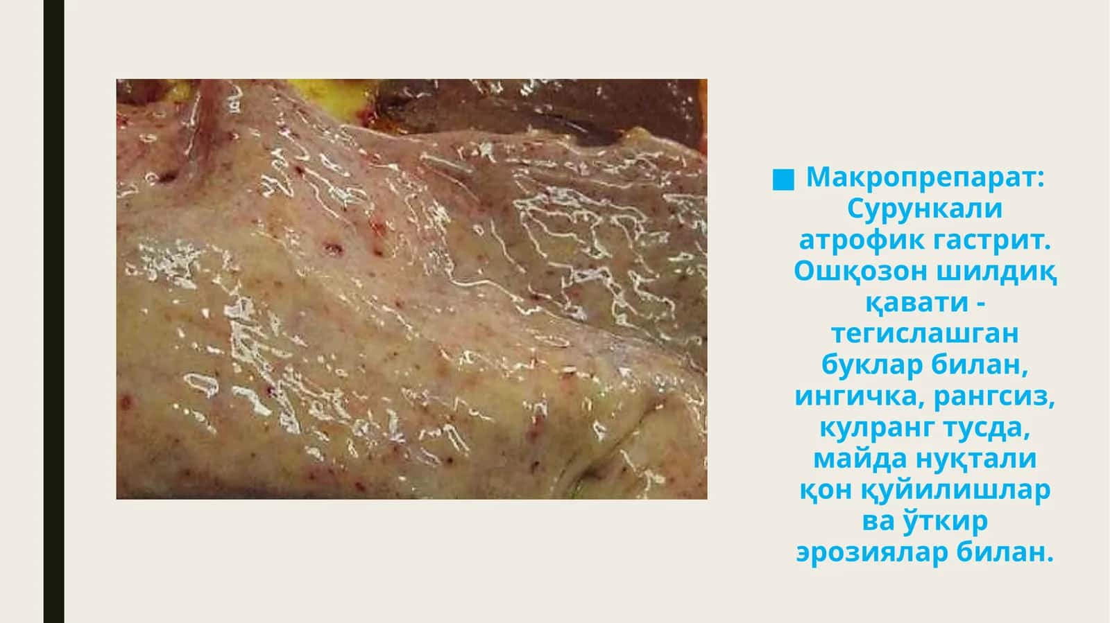 Макропрепарат: Сурункали атрофик гастрит 1
