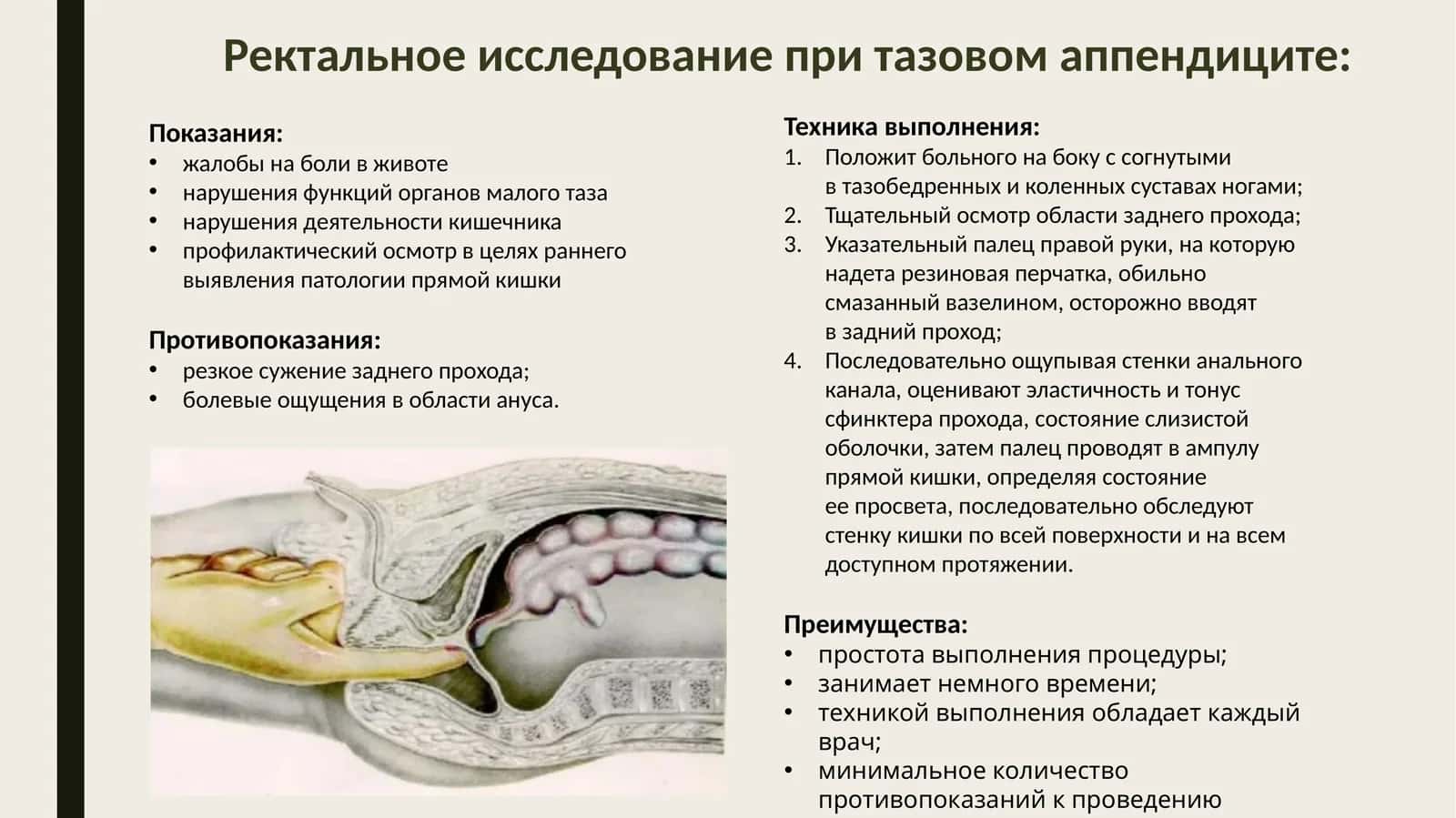 Ректальное исследование при тазовом аппендиците 1