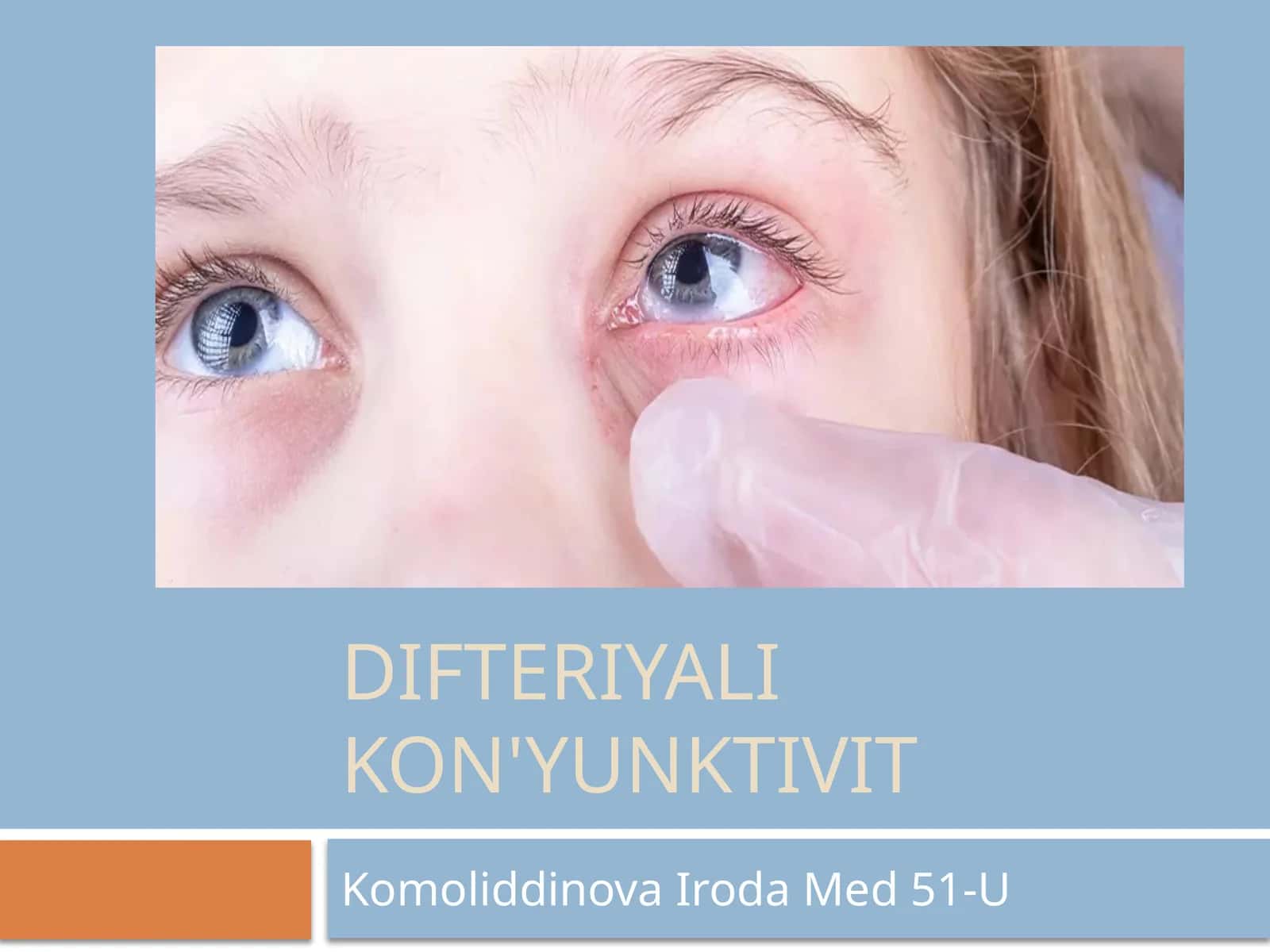Difteriyali kon'yunktivit 1