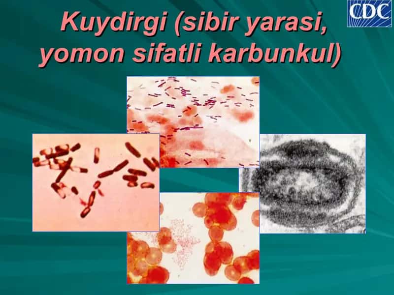 Kuydirgi (sibir yarаsi, yomоn sifаtli kаrbunkul) 1