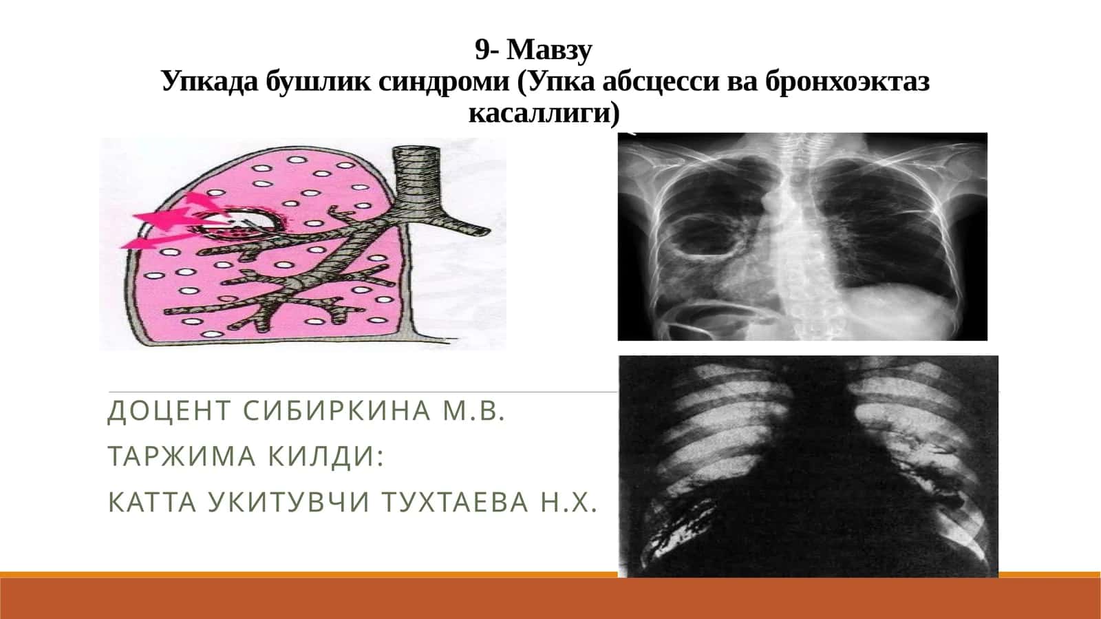 Упкада бушликсиндроми(Упка абсцесси ва бронхоэктаз касаллиги) 1