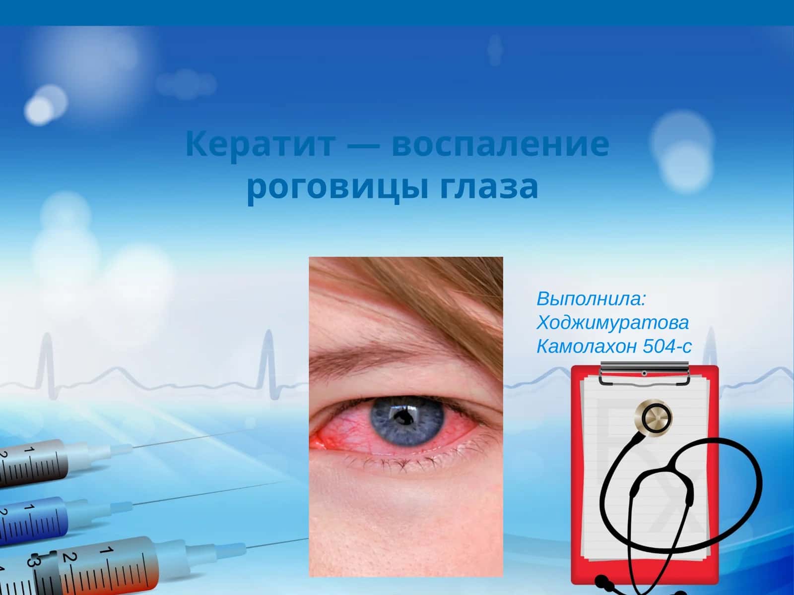 Кератит — воспаление роговицы глаза 1