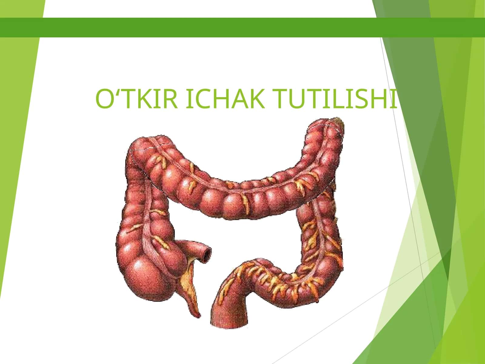 O'tkir ichak tutilishi 1