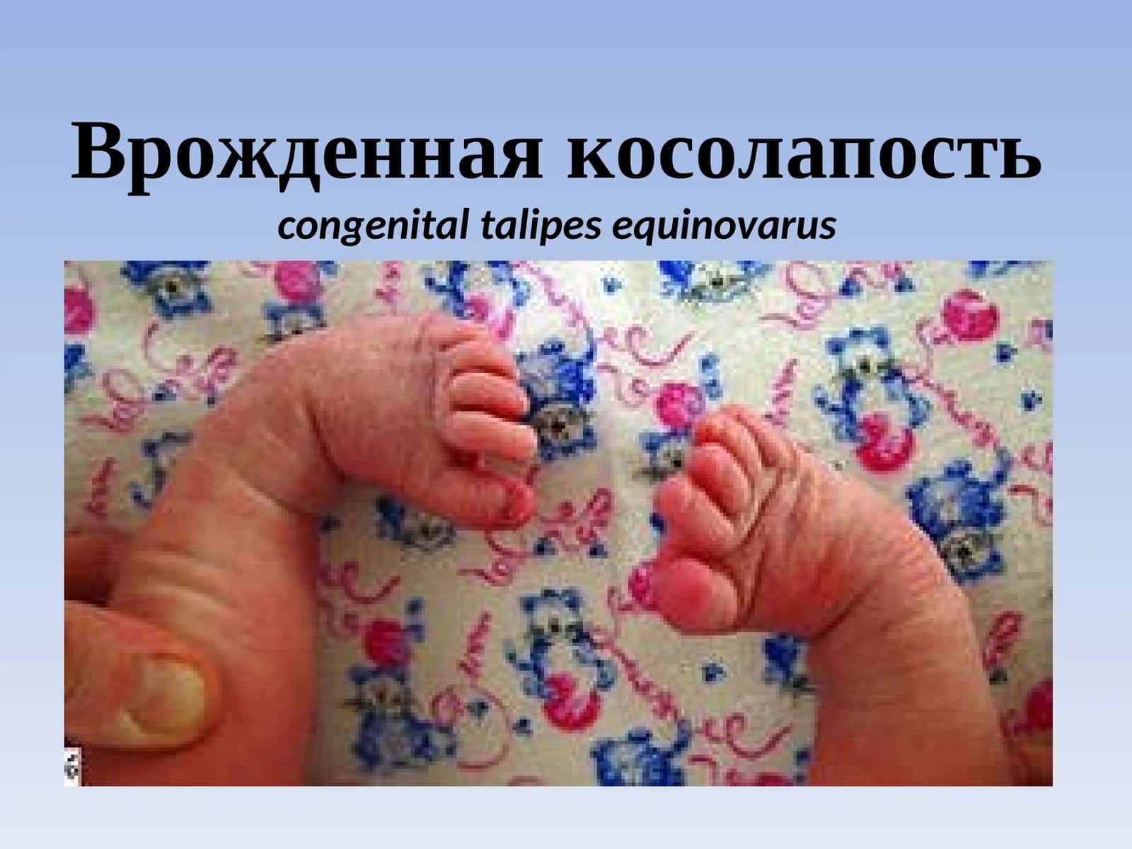 Врожденная косолапость (Congenital talipes equinovarus) 1