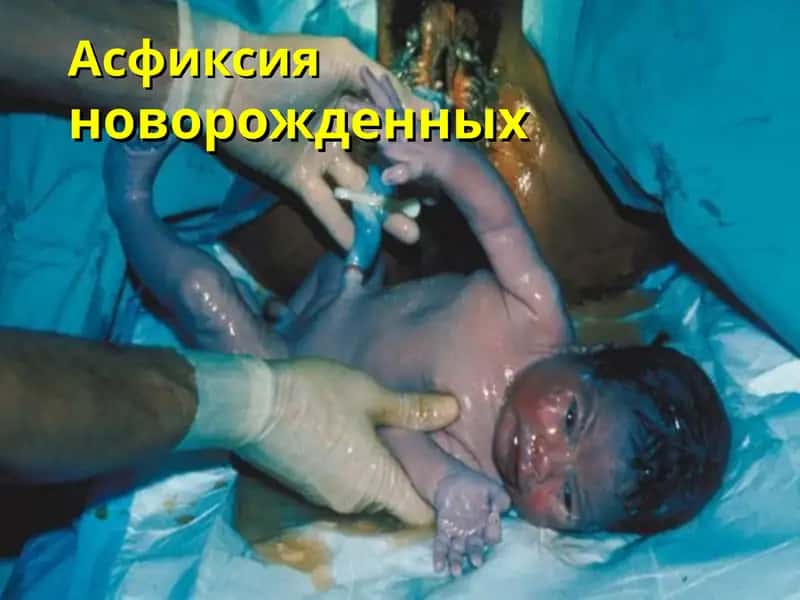 Асфиксия новорожденных 1