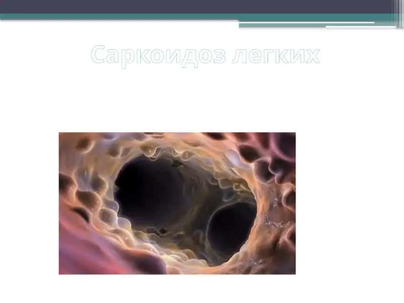Саркоидоз легких 1