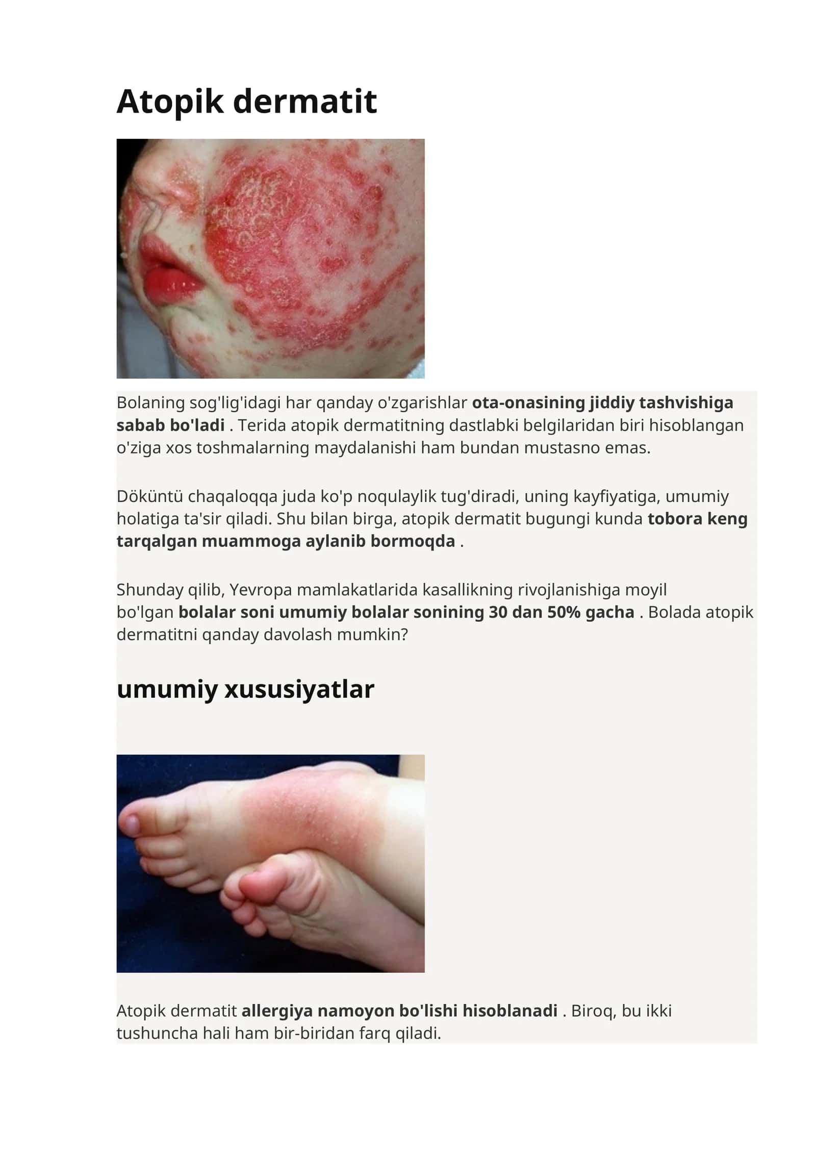 Atopik dermatit 1