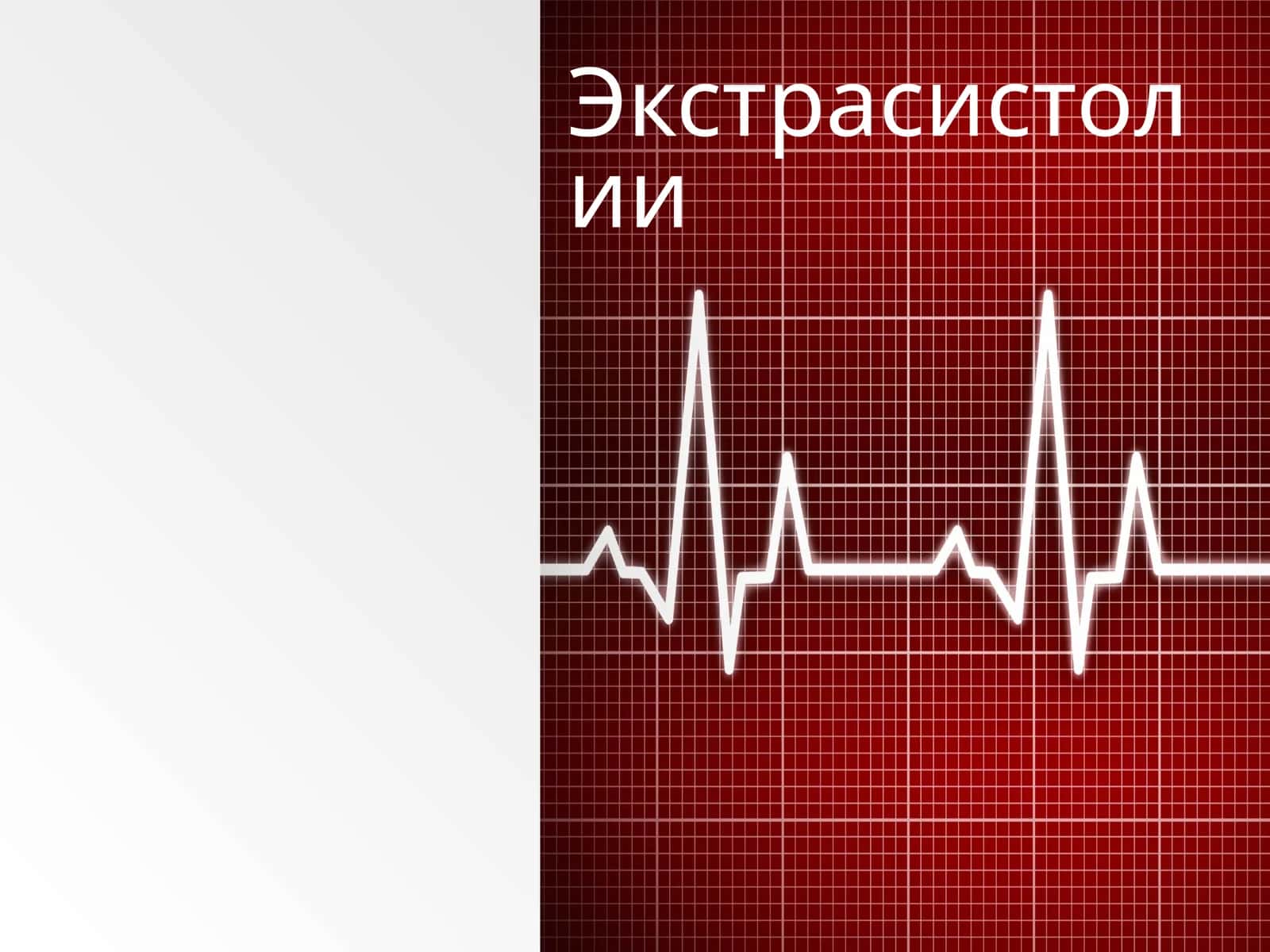 Экстрасистолии 1