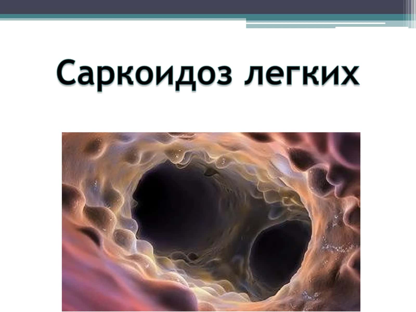 Саркоидоз легких (болезнь Бенье-Бека-Шауманна) 1