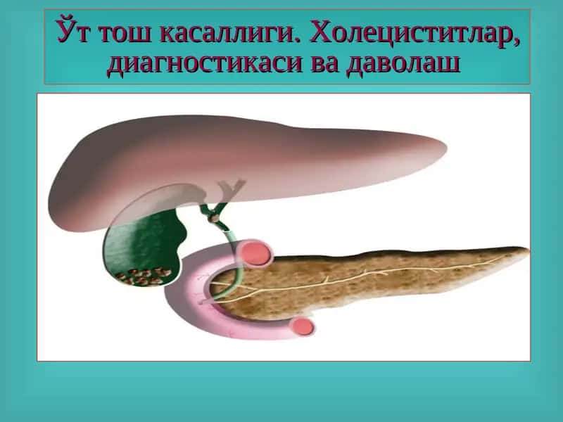 Ўт тош касаллиги. Холециститлар, диагностикаси ва даволаш 1