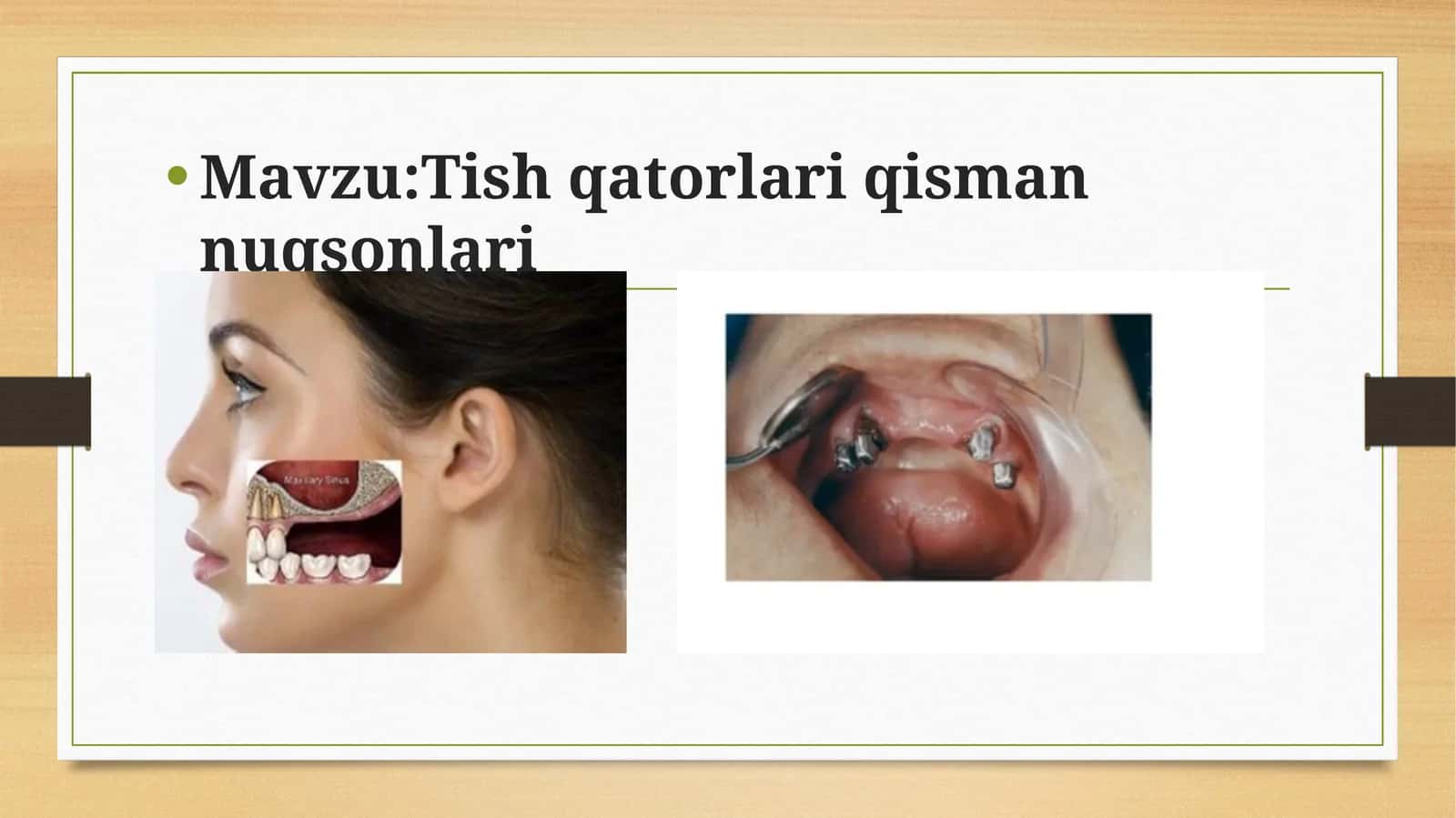 Tish qatorlari qisman nuqsonlari 1