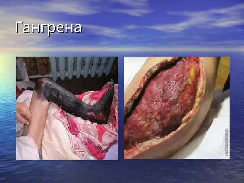 gangrena 1