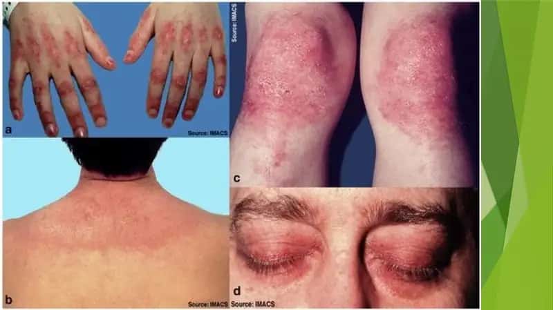 DERMATOMIOZIT 1