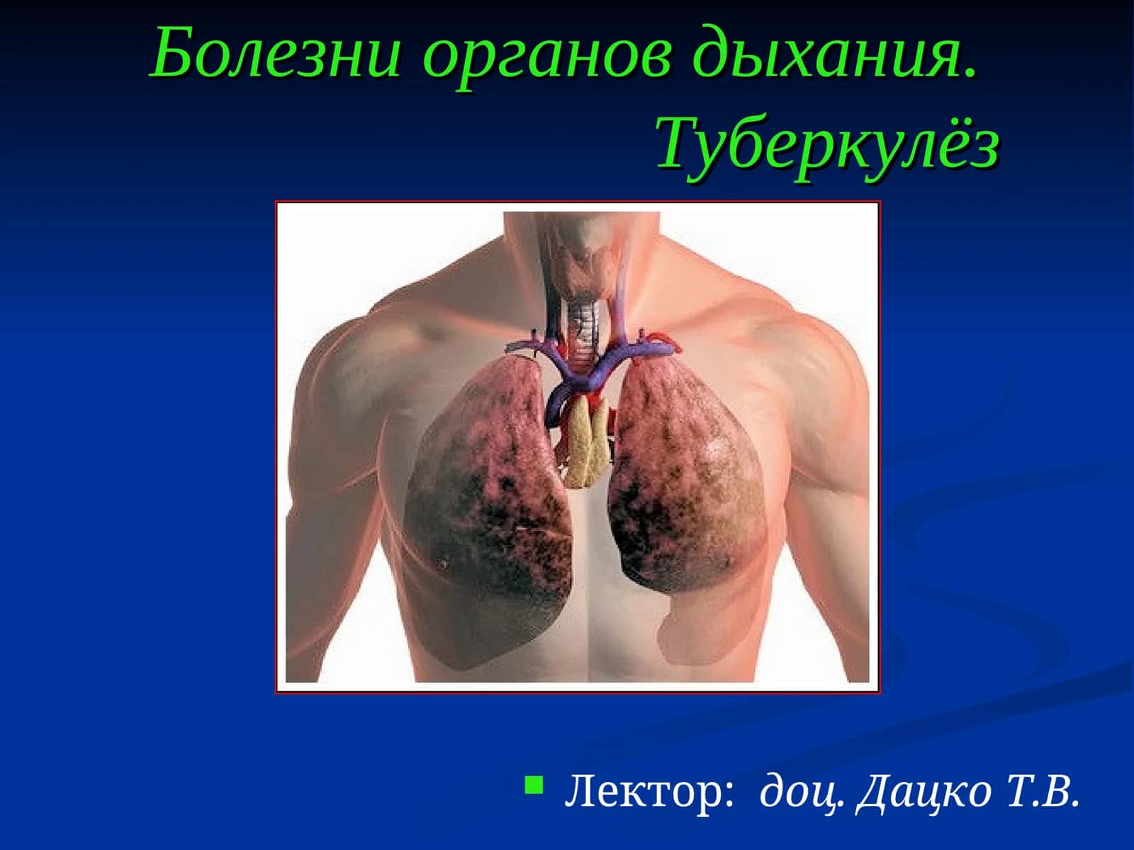 Острый бронхит (bronchitis acuta) 1