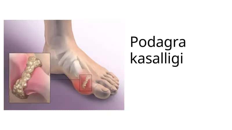 Podagra 1