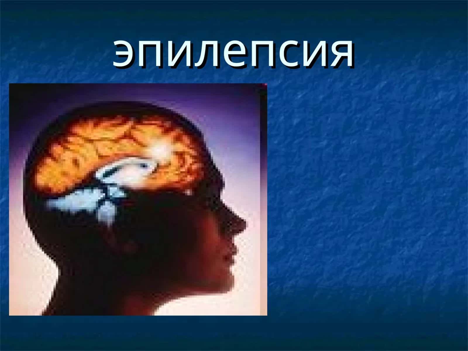 Эпилепсия 1