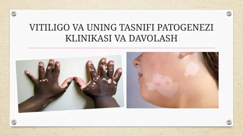 VITILIGO VA UNING TASNIFI PATOGENEZI KLINIKASI VA DAVOLASH 1