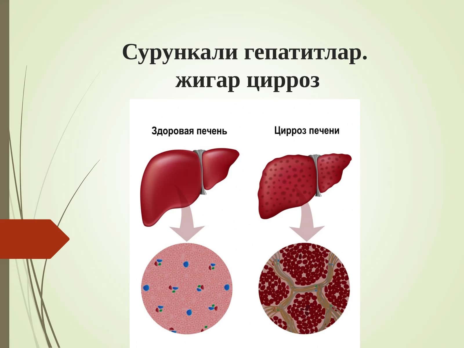 Сурункали гепатитлар. Жигар циррози 1