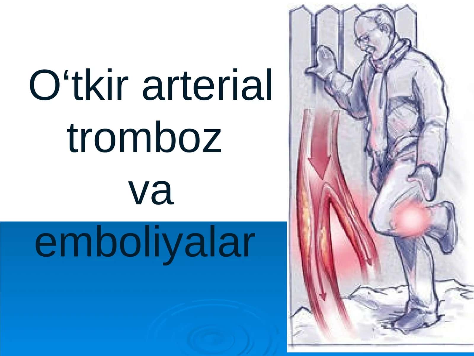 O‘tkir arterial tromboz va emboliyalar 1