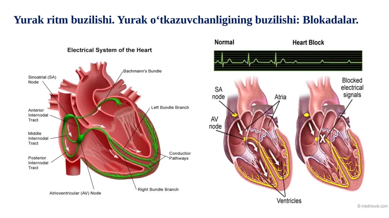 Yurak ritm buzilishi. Yurak o‘tkazuvchanligining buzilishi: Blokadalar. 1