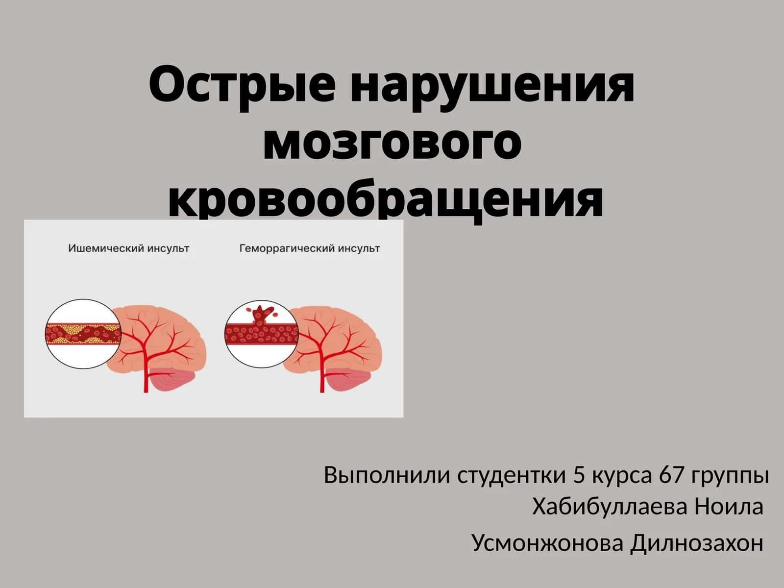 Острые нарушения мозгового кровообращения 1