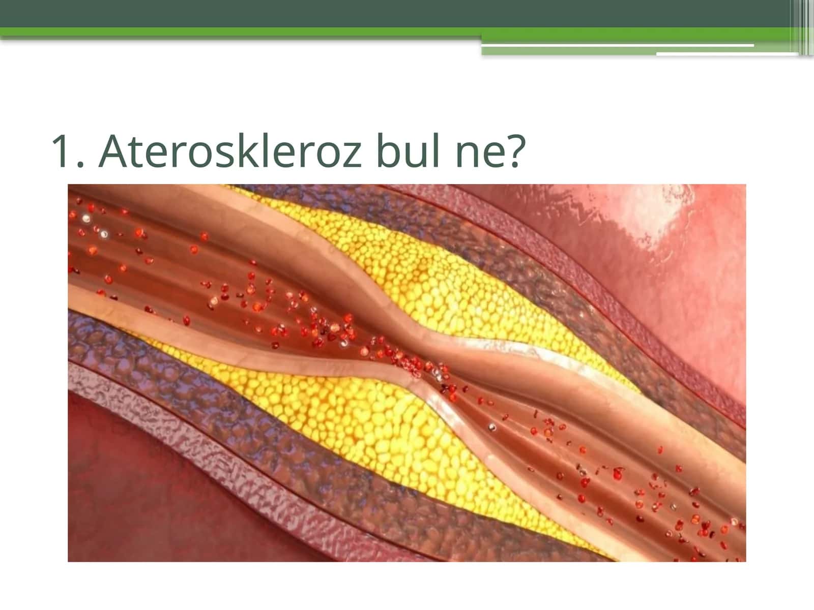 Ateroskleroz 1