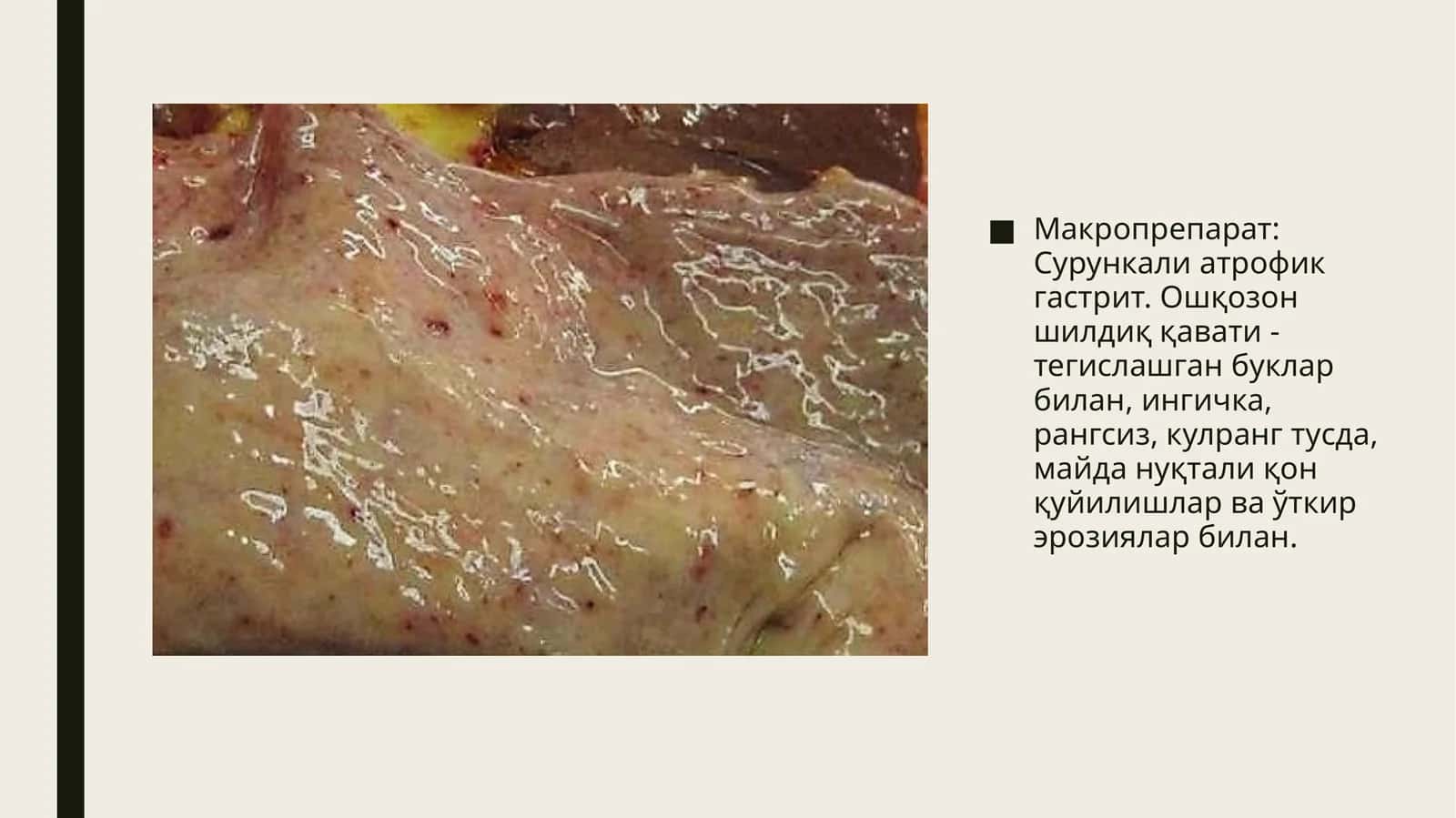 Макропрепарат: Сурункали атрофик гастрит. Микропрепарат: Буйрак амилоидози 1