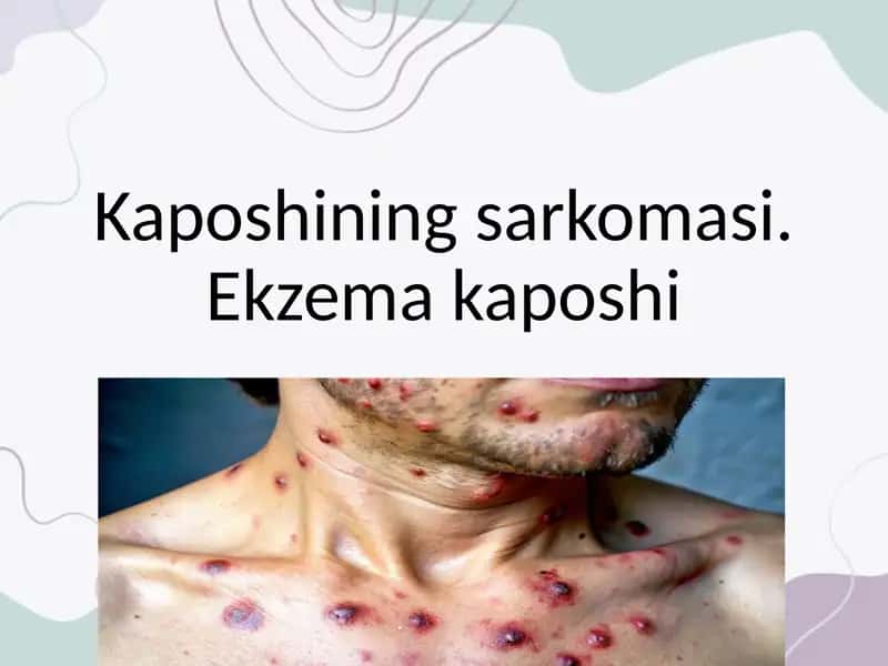 Kaposhining sarkomasi. Ekzema kaposhi 1