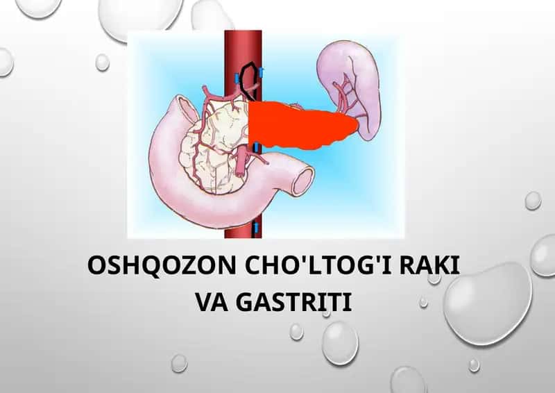 Oshqozonsaratoni 1
