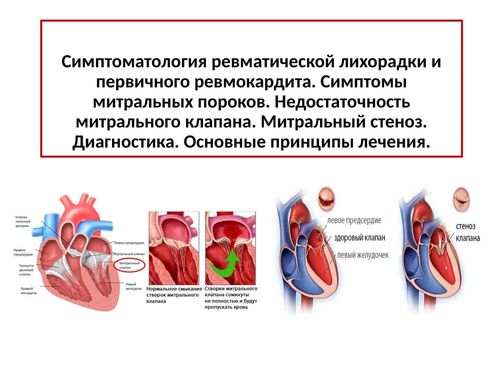 Острая ревматическая лихорадка, определение 1