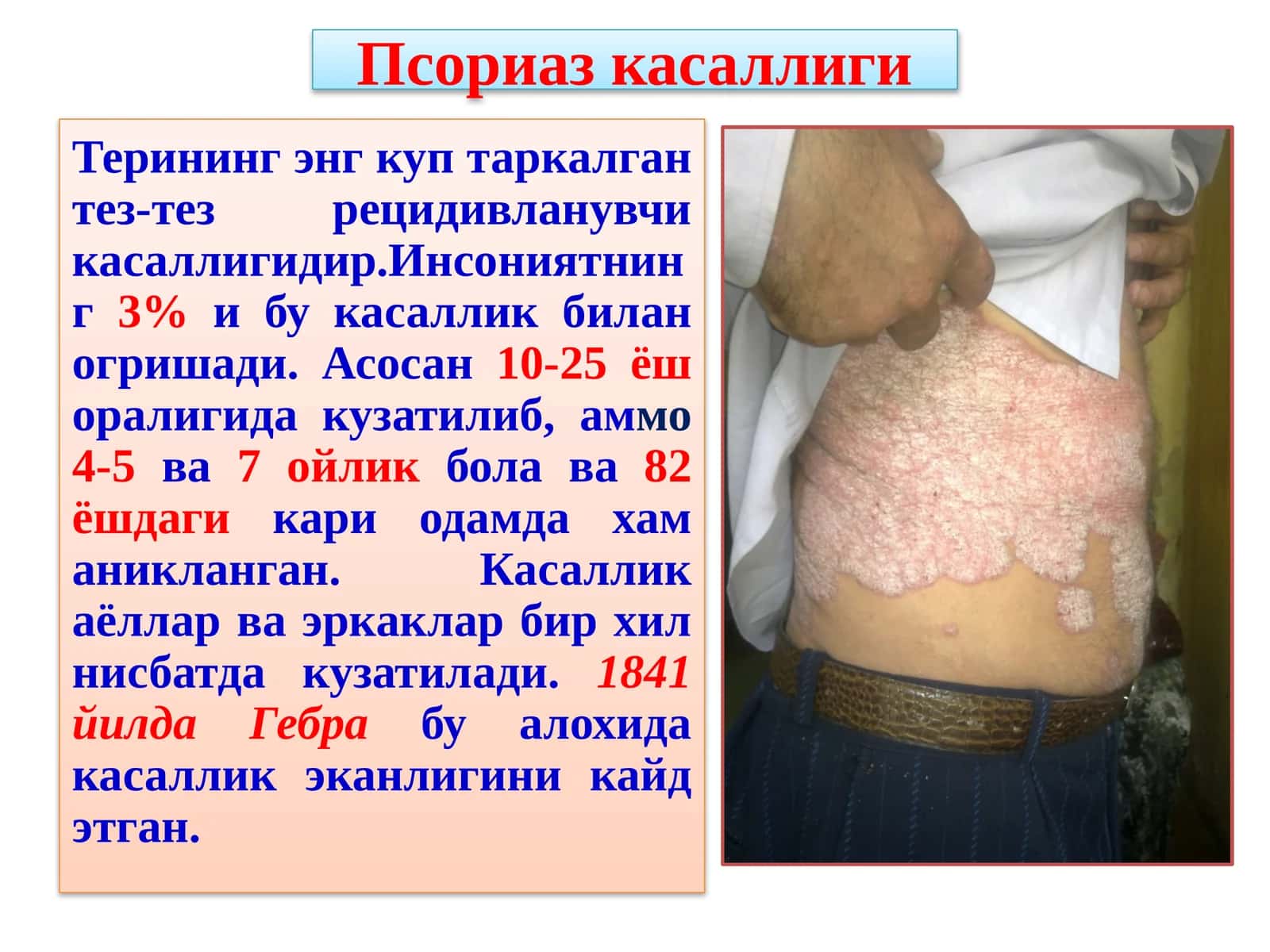 Псориаз касаллиги 1