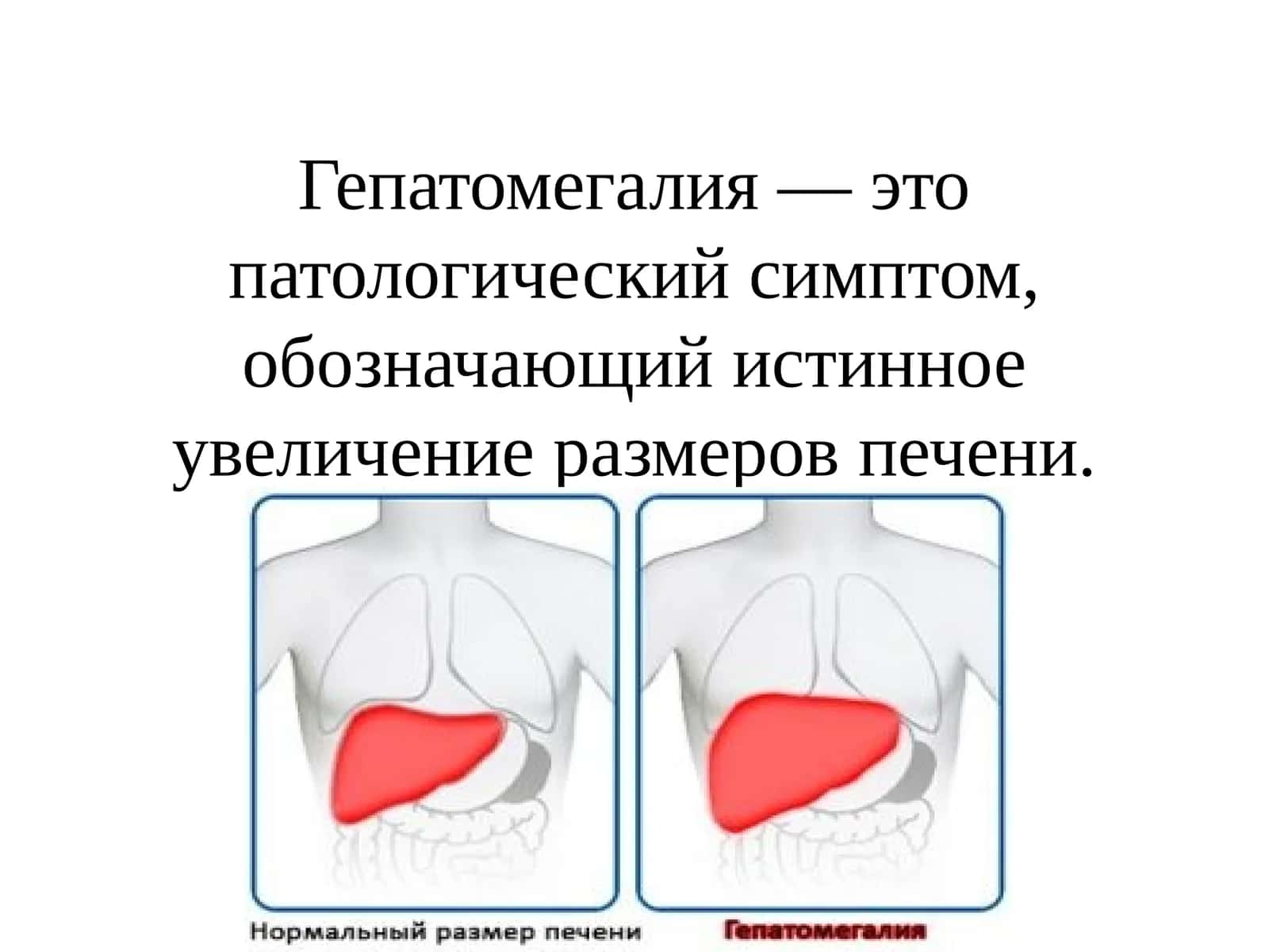 Гепатомегалия — это патологический симптом, обозначающий истинное увеличение размеров печени. 1