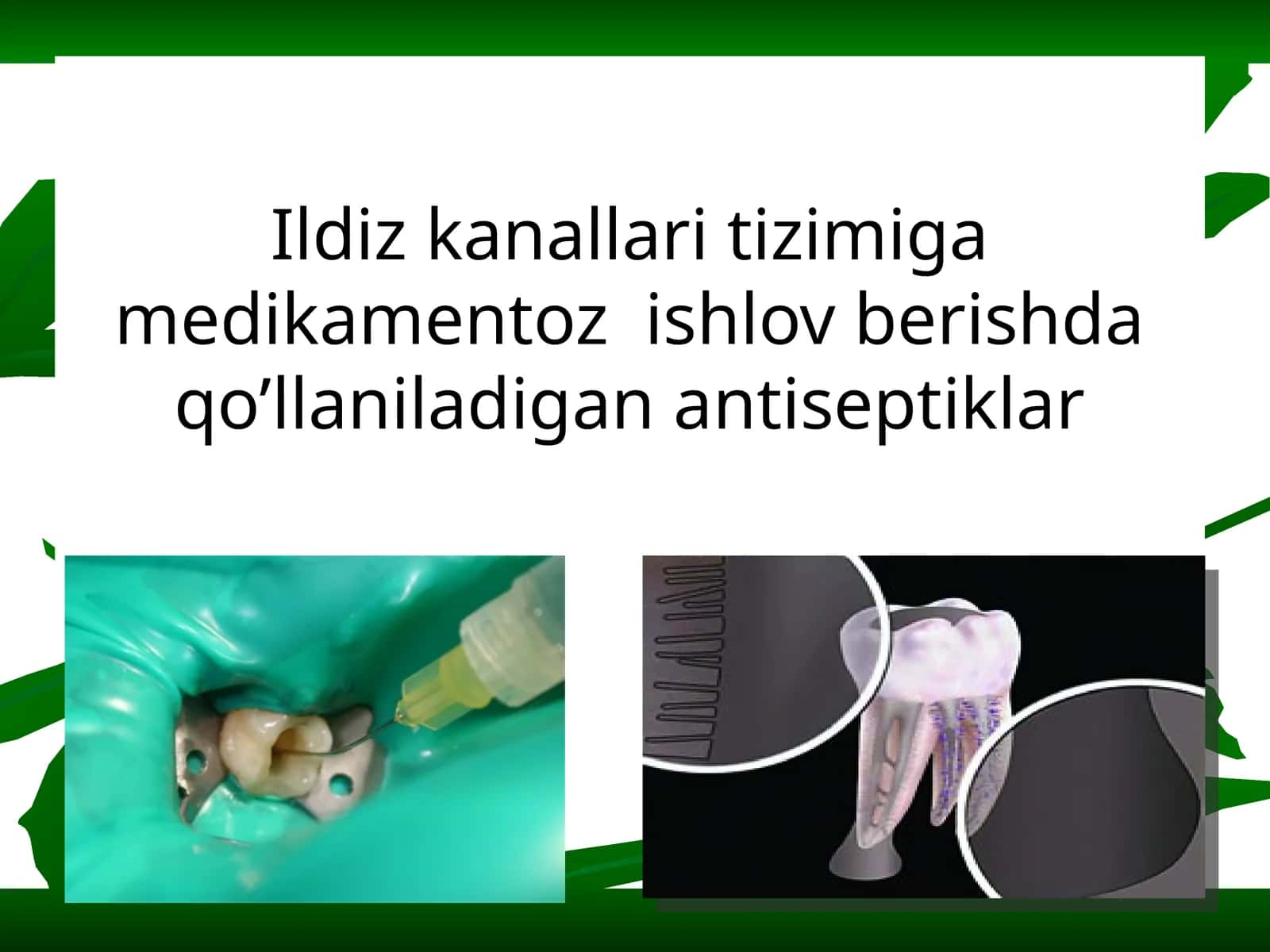 Ildiz kanallari tizimiga medikamentoz  ishlov berishda qo’llaniladigan antiseptiklar 1