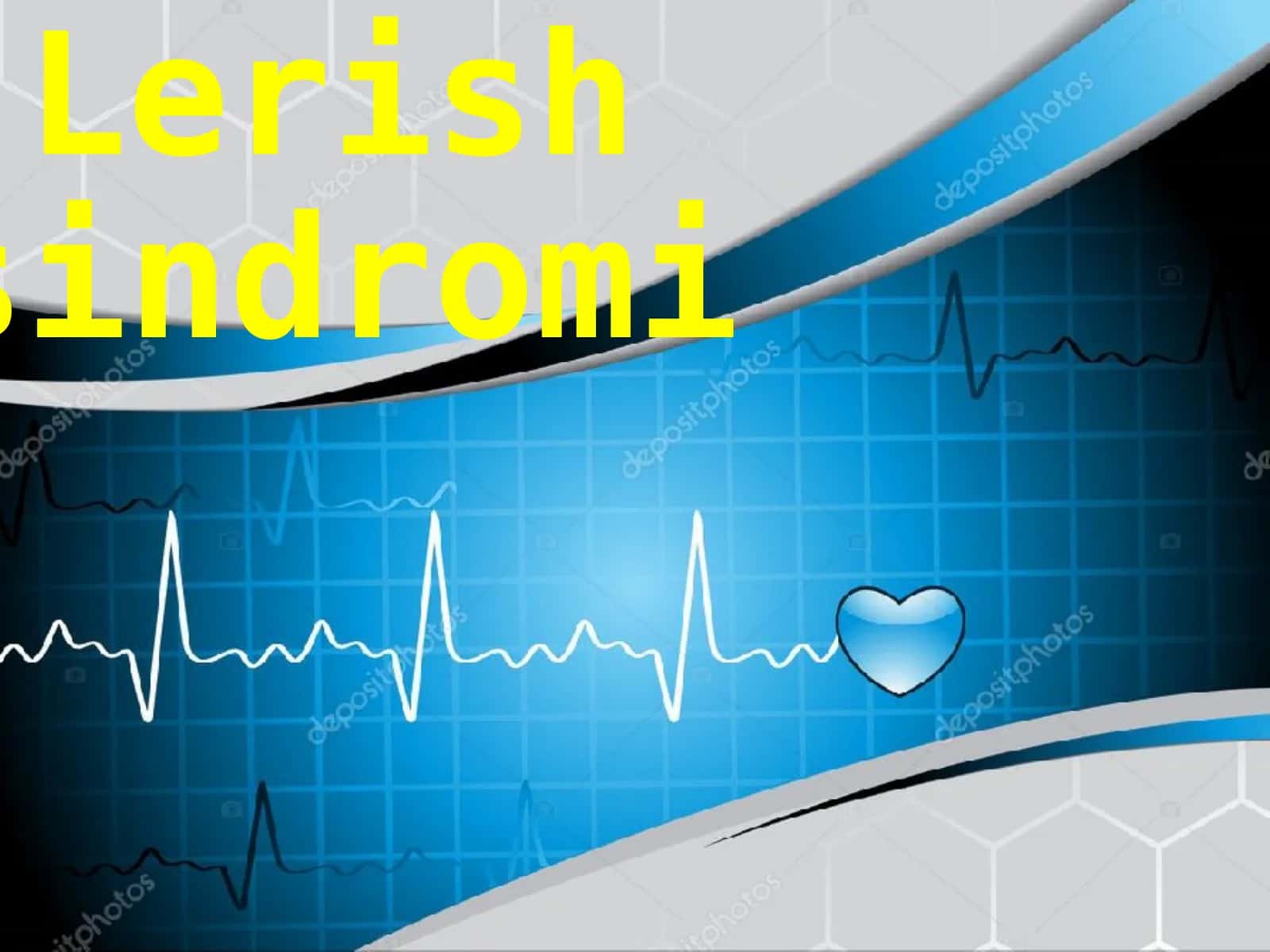 Lerishsindromi 1