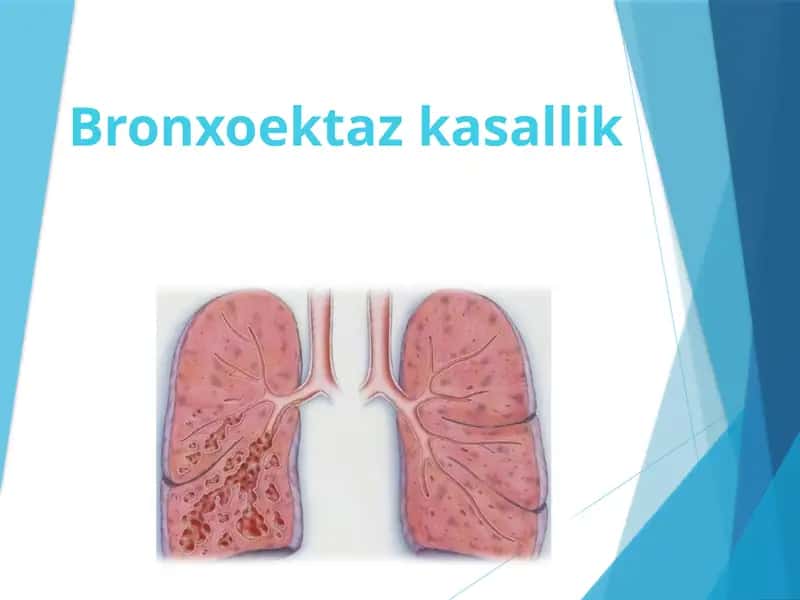 Bronxoektazkasallik 1