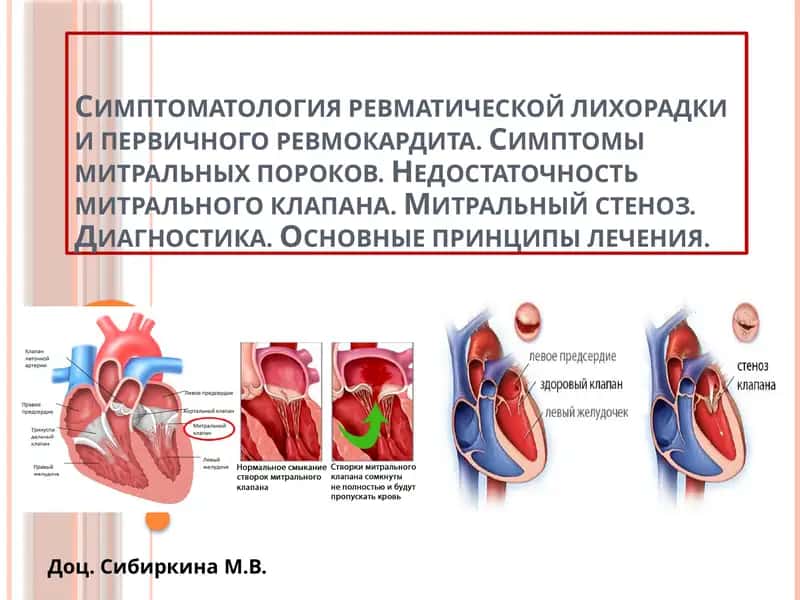 ОСТРАЯ РЕВМАТИЧЕСКАЯ ЛИХОРАДКА, ОПРЕДЕЛЕНИЕ 1