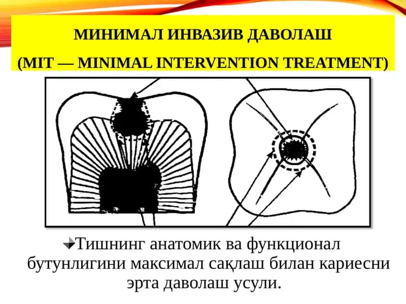 МИНИМАЛ ИНВАЗИВ ДАВОЛАШ (MIT — minimal intervention treatment) 1