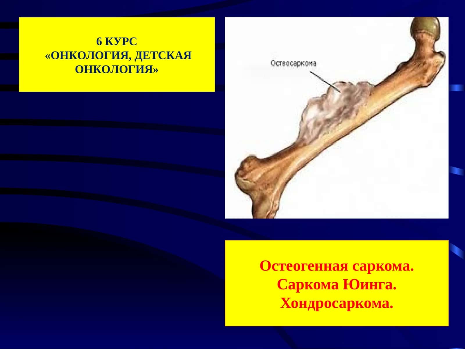 Остеогенная саркома, Саркома Юинга, Хондросаркома: Эпидемиология 1