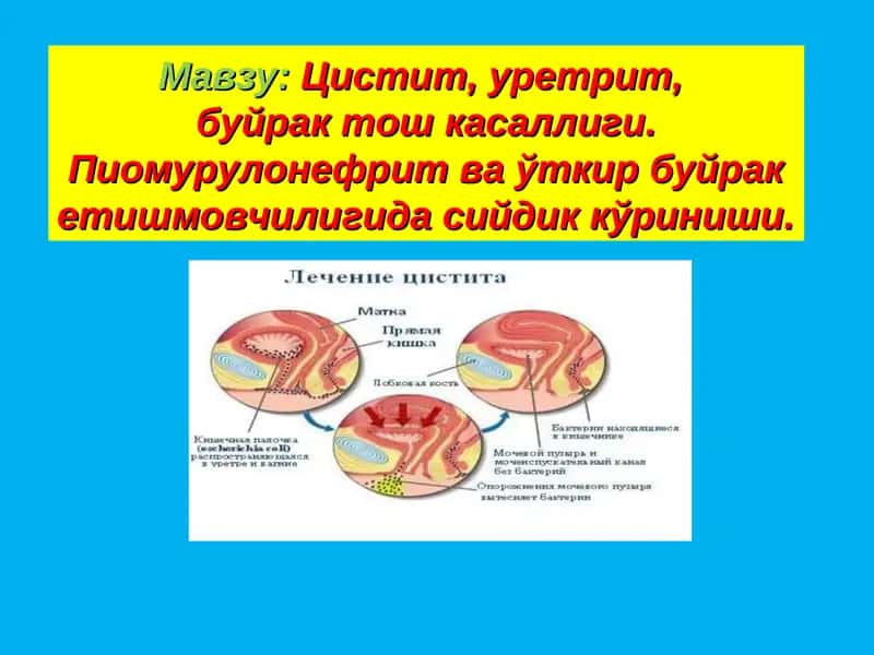Цистит, уретрит, буйрак тош касаллиги 1