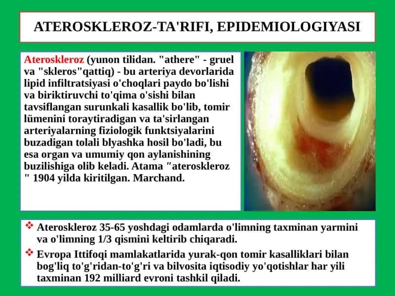 ATEROSKLEROZ-TA'RIFI, EPIDEMIOLOGIYASI 1