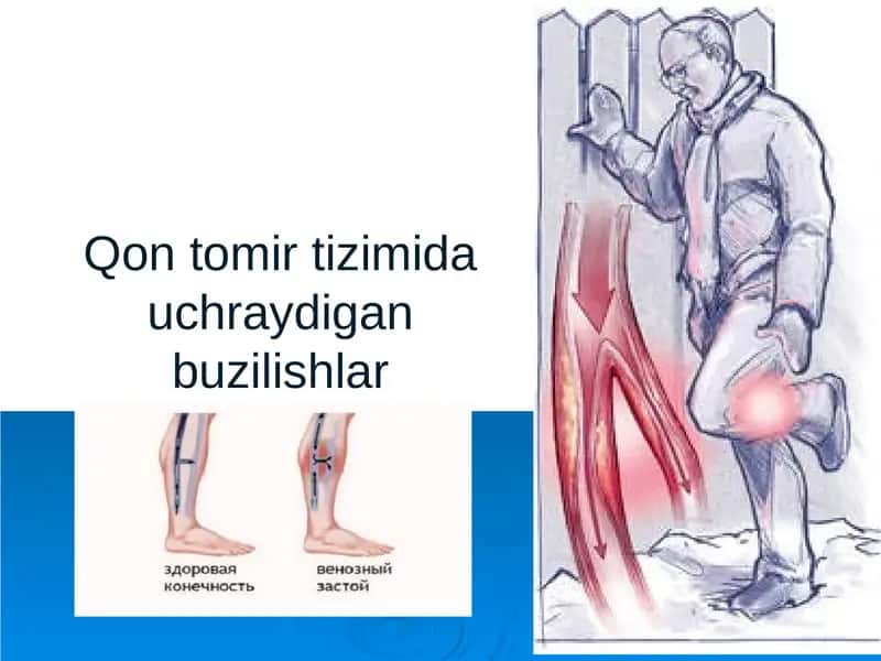 Qon tomir tizimida uchraydigan buzilishlar 1