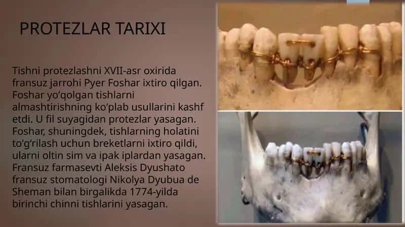 Ortopedik stomatologiyada protez turlari, protezlash 1