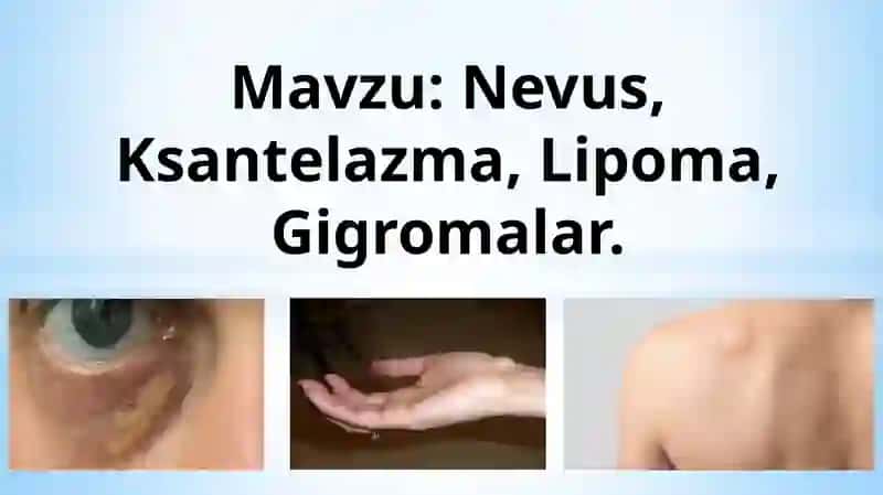 Nevus. Ksantelazma. Lipoma. Gigromalar. 2